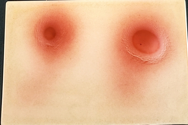 Модель абсцесса (Sim*Abscess) — изображение 2